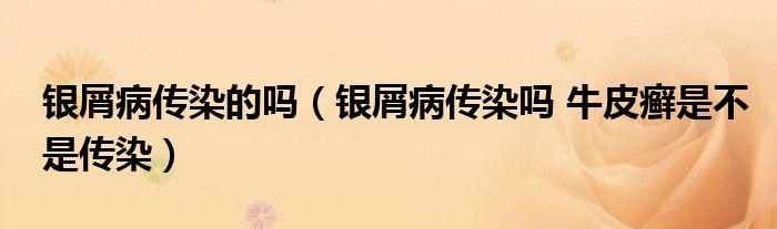 银屑病传染的吗（银屑病传染吗 牛皮癣是不是传染）